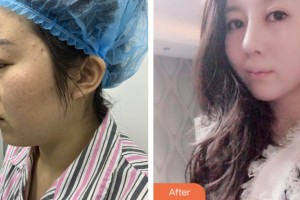 株洲中雅醫(yī)療美容門診部陳瑜整形價格表附耳軟骨復(fù)合隆鼻案例展示