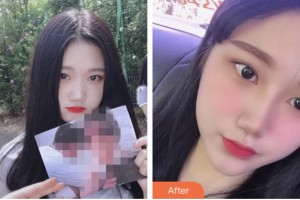 株洲藝佳醫(yī)療美容專科醫(yī)院高謝輝整形價格表附耳軟骨復(fù)合隆鼻案例展示