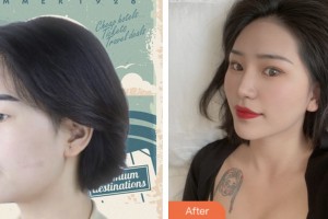 株洲嘉美醫(yī)療整形美容診所賀建湘整形價格表附鼻部綜合案例展示