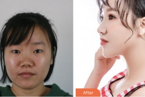 株洲市中心醫(yī)院整形美容科黃挺整形價格表附耳軟骨復(fù)合隆鼻案例展示