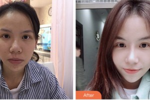 株洲市中心醫(yī)院整形美容科方玉蓉整形價格表附鼻修復(fù)案例展示