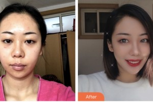 株洲市中心醫(yī)院整形美容科譚朝中整形價格表附鼻部綜合案例展示