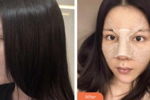 株洲市中心醫(yī)院整形美容科王志強(qiáng)整形價格表附墊鼻基底案例展示