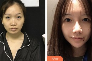 株洲市中心醫(yī)院整形美容科靳海濤整形價格表附鼻部綜合案例展示