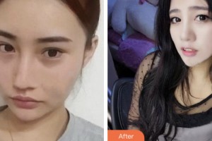 株洲愛思特醫(yī)療美容醫(yī)院林秀青整形價格表附鼻部綜合案例展示