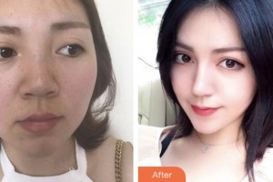 株洲市中心醫(yī)院整形美容科張云華整形價格表附鼻部綜合案例展示