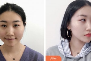 株洲宇芳姬醫(yī)療美容門診部劉明星整形價格表附鼻部綜合案例展示