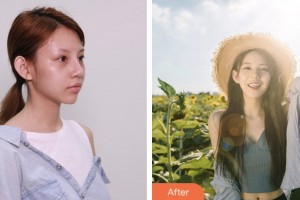 株洲宇芳姬醫(yī)療美容門診部歐陽甜整形價格表附硅膠隆鼻案例展示