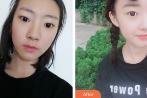 株洲宇芳姬醫(yī)療美容門診部鄭蕎安整形價格表附鼻部綜合案例展示