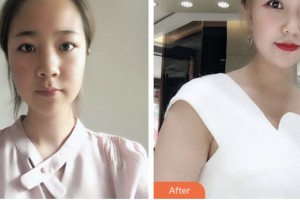 株洲希美醫(yī)療美容門診部唐會勇整形價格表附鼻部綜合案例展示