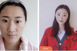 株洲雅美醫(yī)療美容門診部黃益卯整形價格表附鼻部綜合案例展示