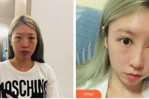 株洲韓美醫(yī)療美容醫(yī)院向平整形價格表附鼻部綜合案例展示