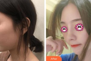 株洲愛爾眼科醫(yī)院尹泳紅整形價(jià)格表附肋軟骨隆鼻案例展示