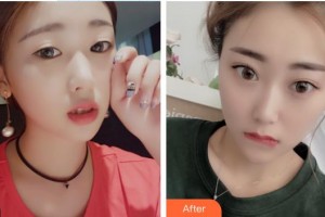 株洲愛爾眼科醫(yī)院歐陽紅專整形價(jià)格表附切開雙眼皮案例展示