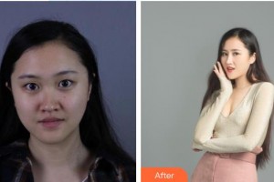 泰州第四人民醫(yī)院整形美容分院錢春華整形價(jià)格表附鼻部綜合案例展示