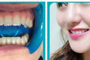 泰州第四人民醫(yī)院整形美容分院張瑋整形價(jià)格表附金屬托槽矯正案例展示