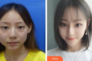 泰州張勤眼科醫(yī)院醫(yī)療美容中心徐慶整形價格表附眼部修復(fù)案例展示