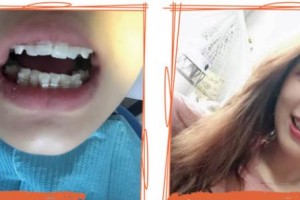 泰州第四人民醫(yī)院整形美容分院劉洋整形價格表附牙齒陶瓷矯正案例展示