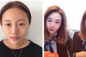 泰州愛(ài)爾眼科醫(yī)院王秋燕整形價(jià)格表附眼部綜合案例展示