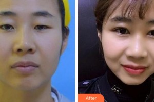 泰州愛(ài)爾眼科醫(yī)院胡正再整形價(jià)格表附切開(kāi)雙眼皮案例展示