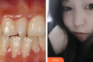 泰州玲瓏口腔門診部秦琳玲整形價格表附金屬托槽矯正案例展示