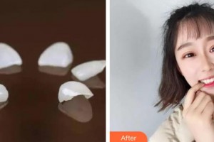 泰州拜博口腔醫(yī)院范琳琳整形價格表附美白貼片案例展示