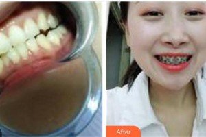 泰州玲瓏口腔門診部黃榮明整形價格表附金屬托槽矯正案例展示