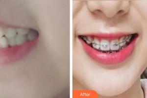 鎮(zhèn)江市第一人民醫(yī)院美容整形科嚴(yán)志新整形價格表附金屬托槽矯正案例展示