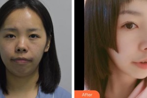 鎮(zhèn)江華美醫(yī)療美容門診部宋明義整形價格表附鼻部綜合案例展示