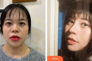 鎮(zhèn)江康復(fù)眼科醫(yī)院（鎮(zhèn)江市第—人民醫(yī)院眼科）張芹整形價格表附肋軟骨隆鼻案例展示