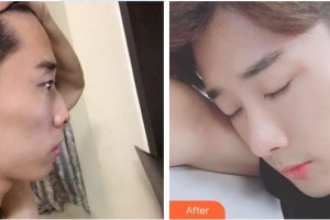 鎮(zhèn)江市第一人民醫(yī)院美容整形科王兵整形價(jià)格表附鼻部綜合案例展示