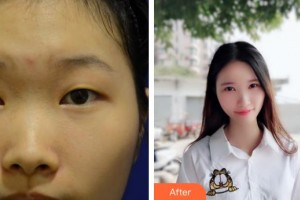 鎮(zhèn)江華儷醫(yī)療美容門診部鄭婷整形價(jià)格表附切開雙眼皮案例展示