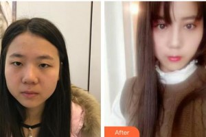 鎮(zhèn)江華儷醫(yī)療美容門診部戴星整形價(jià)格表附切開雙眼皮案例展示