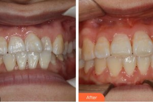 鎮(zhèn)江拜博口腔門診部李娜整形價(jià)格表附牙齒陶瓷矯正案例展示