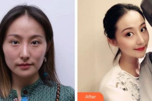 湘潭雅美醫(yī)療美容醫(yī)院劉志剛整形價(jià)格表附鼻部綜合案例展示