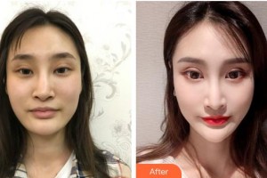 湘潭雅美醫(yī)療美容醫(yī)院何敏整形價(jià)格表附墊鼻基底案例展示