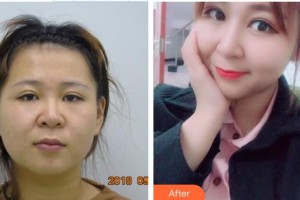 湘潭市中心醫(yī)院醫(yī)學(xué)整形美容科肖學(xué)敏住院醫(yī)師整形價(jià)格表附鼻部綜合案例展示