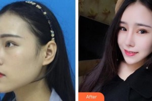 湘潭市紅十字仁和醫(yī)院整形美容中心宋蕾整形價(jià)格表附鼻部綜合案例展示