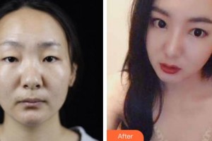 湘潭華雅整形美容醫(yī)院吳買平整形價(jià)格表附鼻部綜合案例展示