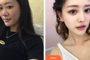 湘潭華美整形醫(yī)院賓仁整形價(jià)格表附鼻部綜合案例展示