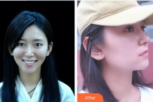 湘潭雅美醫(yī)療美容醫(yī)院鄭敏敏整形價(jià)格表附鼻部綜合案例展示