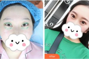 湘潭陽光門診部譚兵整形價(jià)格表附眼部綜合案例展示