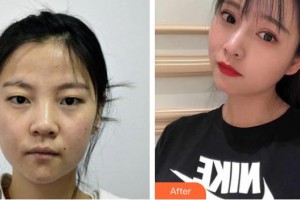 湘潭愛爾眼科醫(yī)院王瑞平整形價(jià)格表附切開雙眼皮案例展示