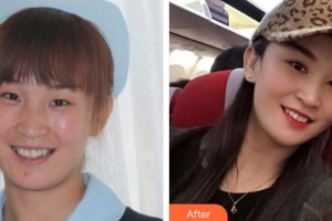 湘潭愛爾眼科醫(yī)院劉祥明整形價(jià)格表附眼部綜合案例展示