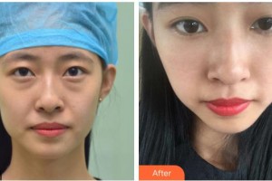 湘潭愛爾眼科醫(yī)院李仁華整形價(jià)格表附內(nèi)切祛眼袋案例展示