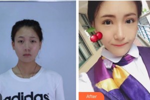 湘潭愛爾眼科醫(yī)院毛安真整形價(jià)格表附眼部整形案例展示