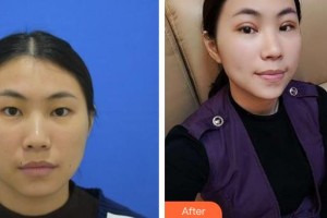 湘潭愛爾眼科醫(yī)院羅皓平整形價(jià)格表附定點(diǎn)雙眼皮案例展示