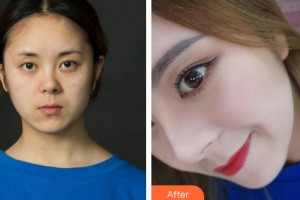 永州新唯美整形美容醫(yī)院薛澈煥整形價格表附鼻部綜合案例展示