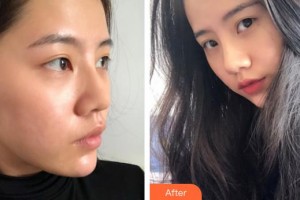 永州博美整形美容醫(yī)院劉躍珠整形價格表附鼻修復(fù)案例展示