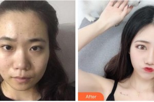 永州星雅醫(yī)療美容門診部張光輝整形價格表附鼻部綜合案例展示